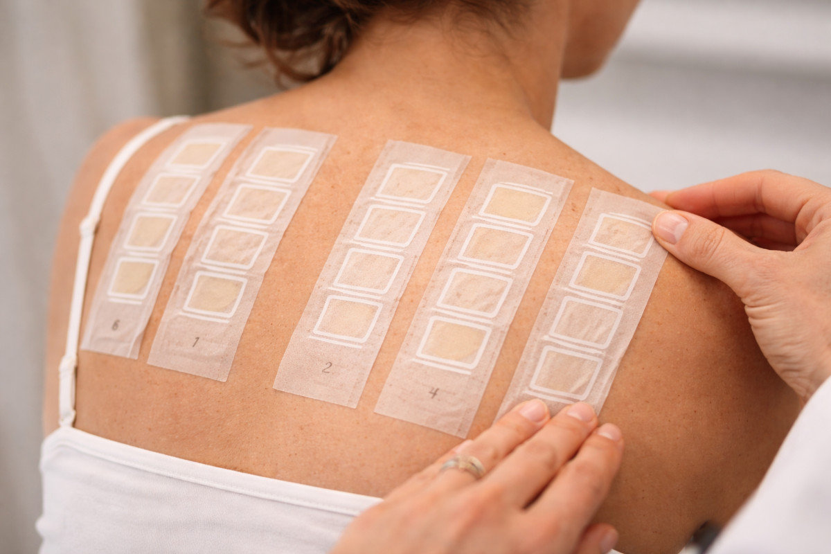 Patch test applicato sulla schiena per la diagnosi di dermatite allergica — studio Roma
