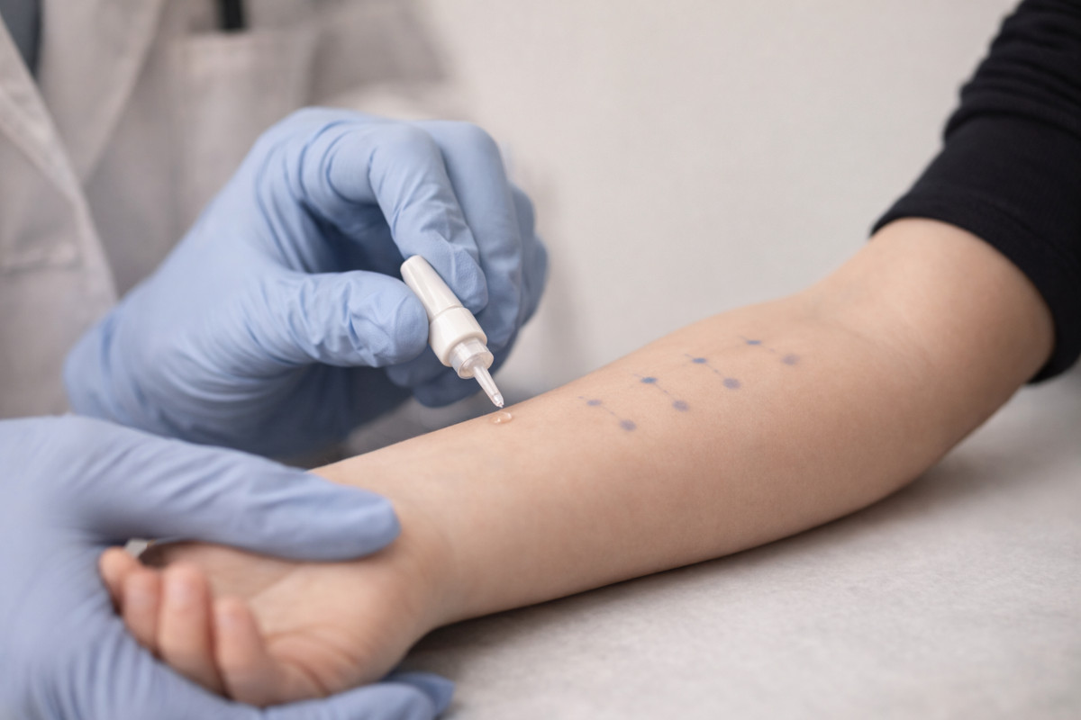 Prick test per allergie alimentari sull'avambraccio — studio allergologico Roma